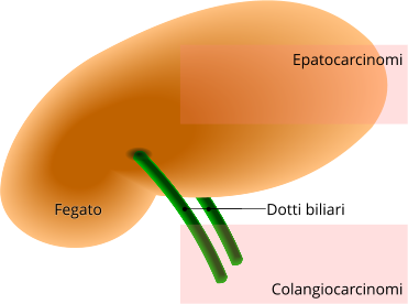 Tumori del fegato: epatocarcinoma e colangiocarcinoma